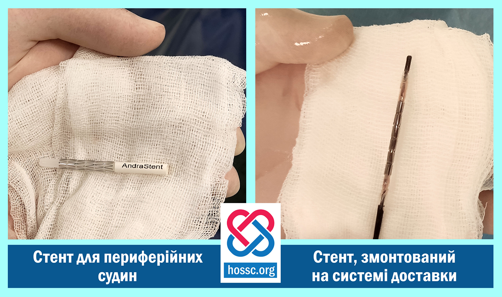 Новини Хмельницького - фото з У Хмельницькому кардіологи врятували чоловіка від ампутації ноги На зображенні може бути: 2 людини та текст «AndraStent стент для периферийних судин ශ hossc.org стент, змонтований на системi̇ доставки»