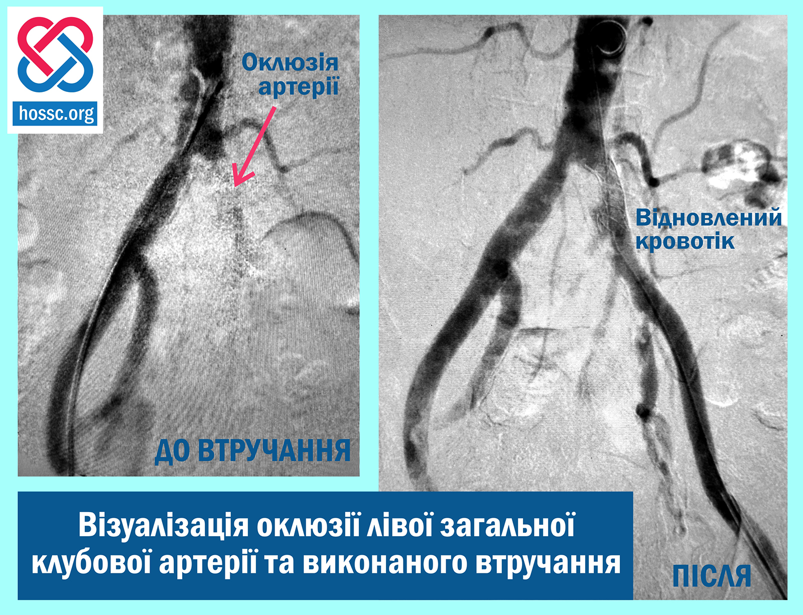 Новини Хмельницького - фото з У Хмельницькому кардіологи врятували чоловіка від ампутації ноги На зображенні може бути: текст