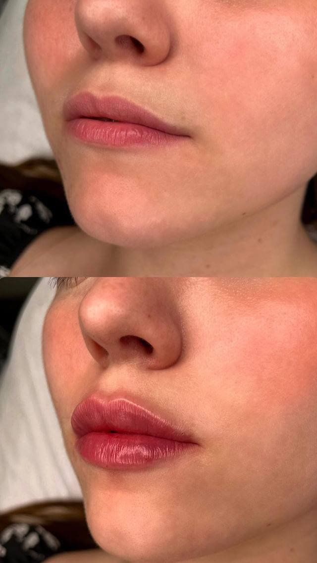 Новини Вінниці - фото з З якого віку можна збільшувати губи? Розповідає вінницька косметологиня