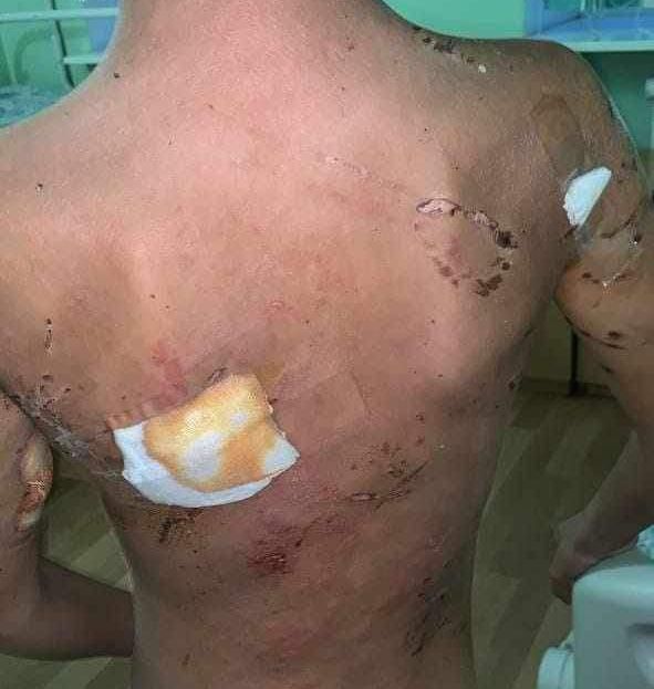 Новини Вінниці - фото з «Я не хочу помирати!» У Жмеринці 12-річного хлопчика покусали собаки