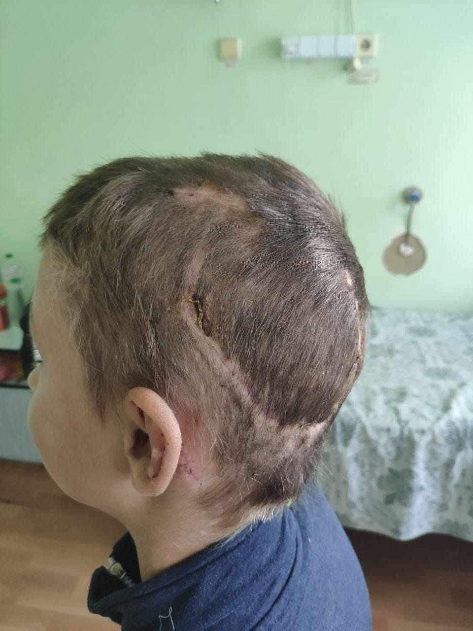 Новини Вінниці - фото з «Я не хочу помирати!» У Жмеринці 12-річного хлопчика покусали собаки