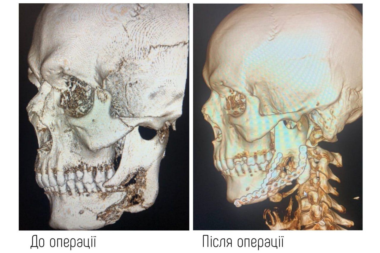Новини Вінниці - фото з У «пироговці» пацієнту провели реконструкцію обличчя після важких травм