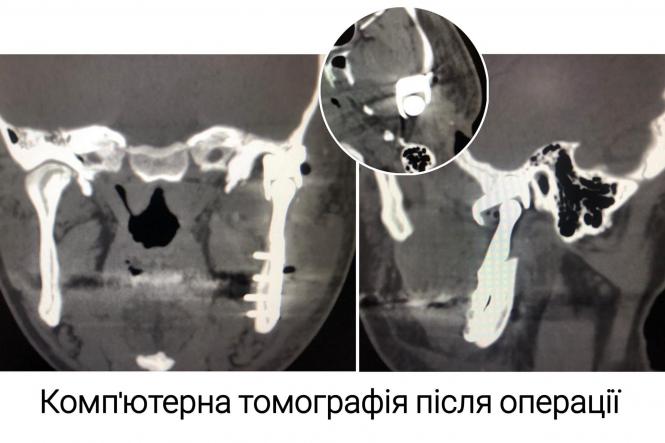 Новини Вінниці - фото з У «Пироговці» хірурги провели унікальну операцію на щелепі