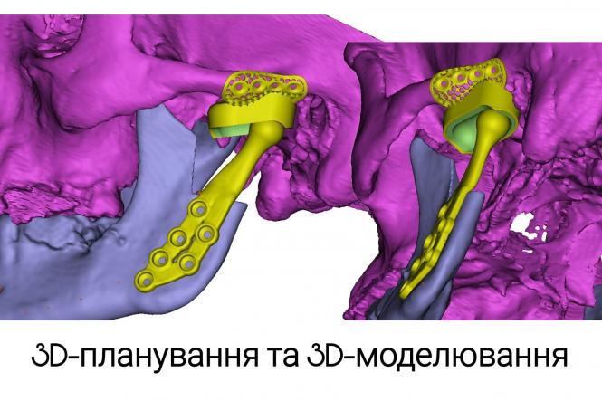 Новини Вінниці - фото з У «Пироговці» хірурги провели унікальну операцію на щелепі