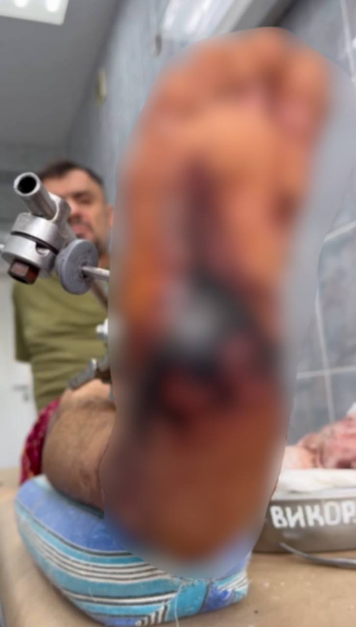 Новини Тернополя - фото з Він хоче ходити і повернутися на фронт: родина захисника з Теребовлі збирає 700 тисяч на лікування