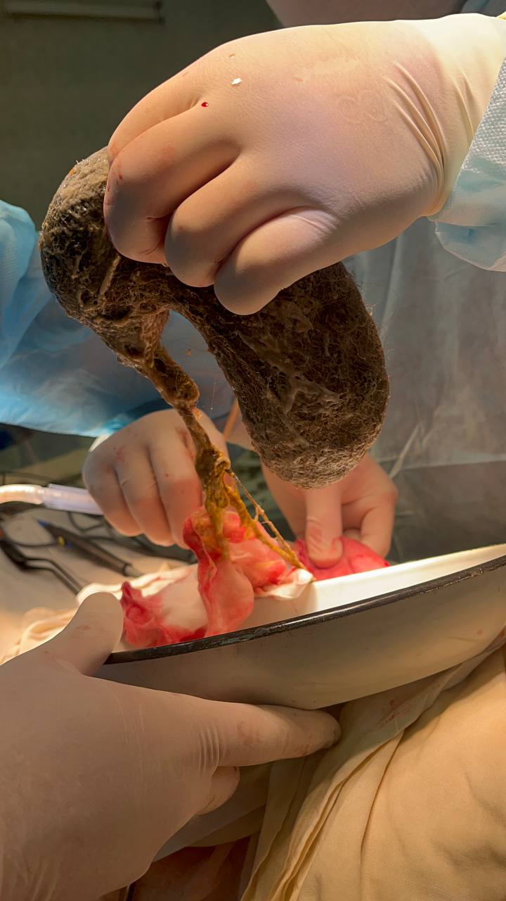 Новини Козятина - фото з Зі шлунку 11-річної дівчинки обласні хірурги дістали величезний жмут волосся