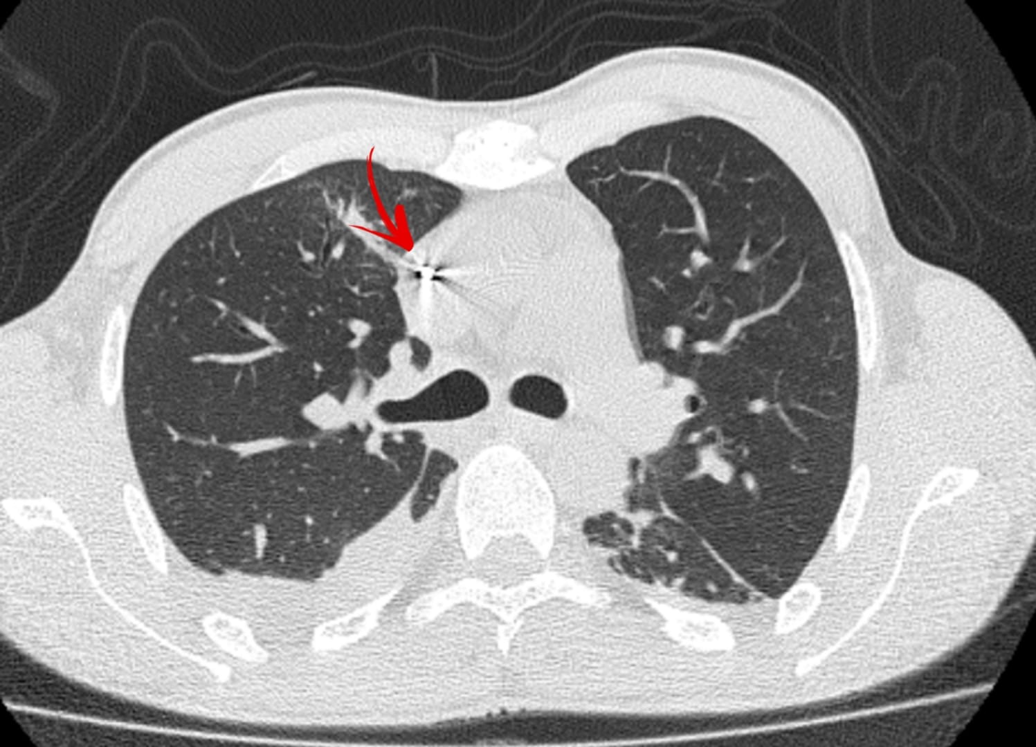 Новини Вінниці - фото з У Вінниці команда хірургів видалила металевий уламок з серця пацієнта