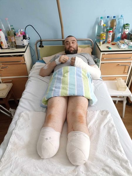 Новини Житомира - фото з Дружина Захисника Андрія Гнатенка звертається по допомогу: потрібна реабілітація після ампутації ступнів ніг
