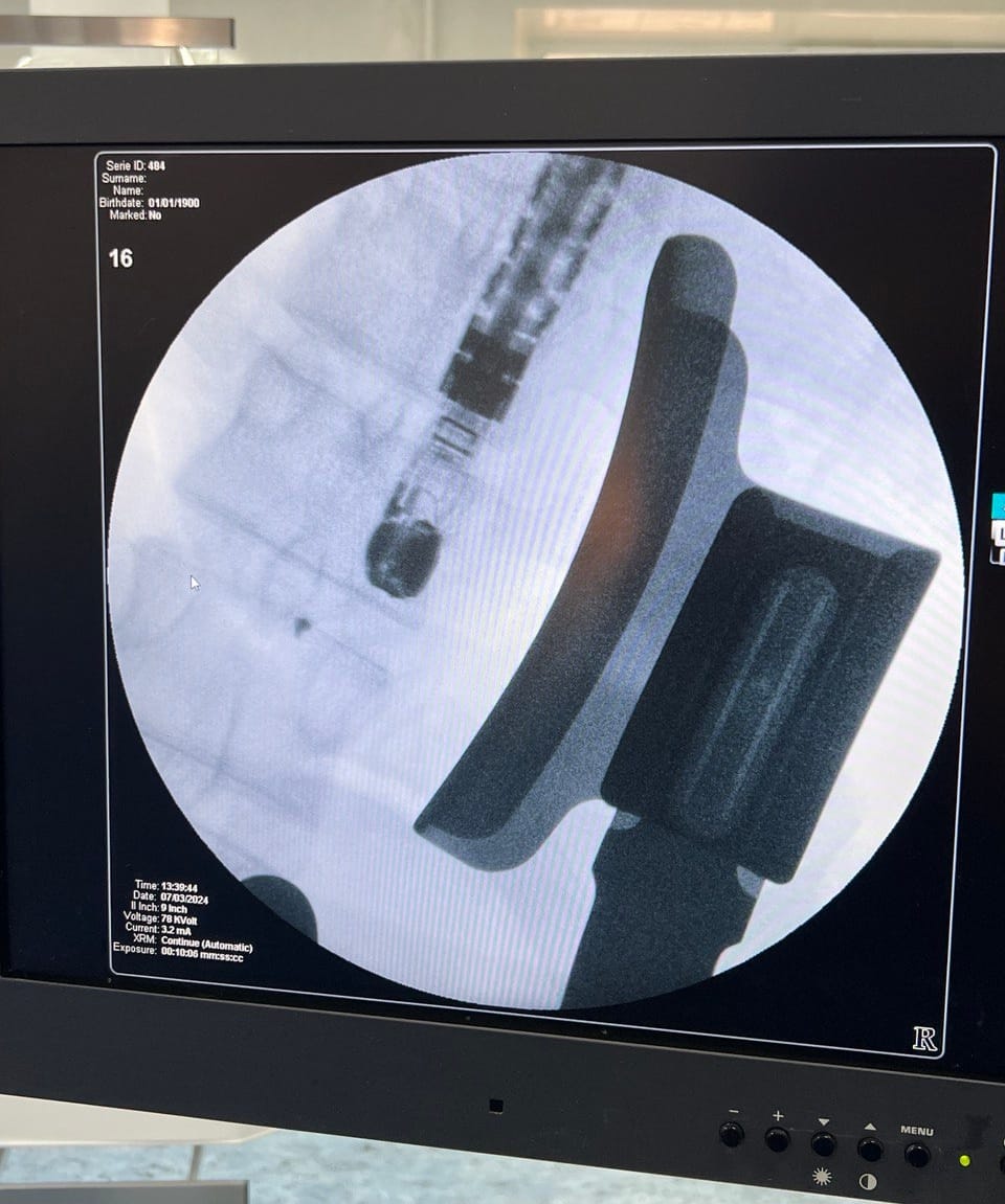 Новини Вінниці - фото з Кардіохірурги видалили металеві уламки з працюючого серця пацієнта