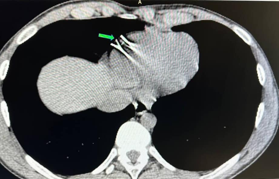 Новини Вінниці - фото з Кардіохірурги видалили металеві уламки з працюючого серця пацієнта