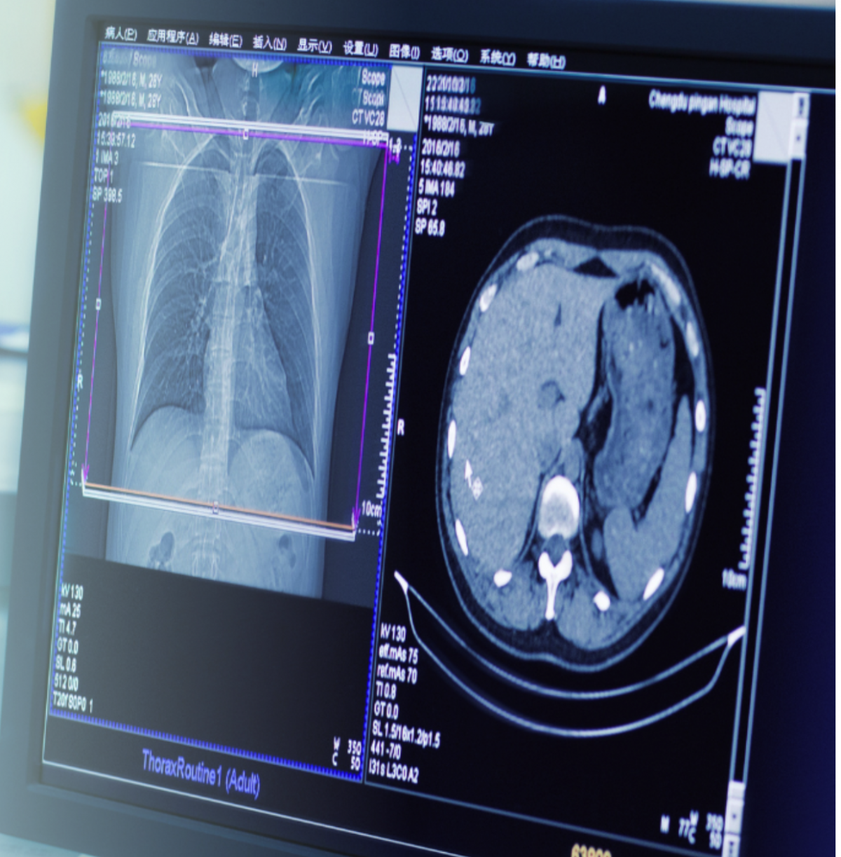 Новини Вінниці - фото з Вже можна записуватись на безоплатну комп’ютерну томографію в онкоцентр