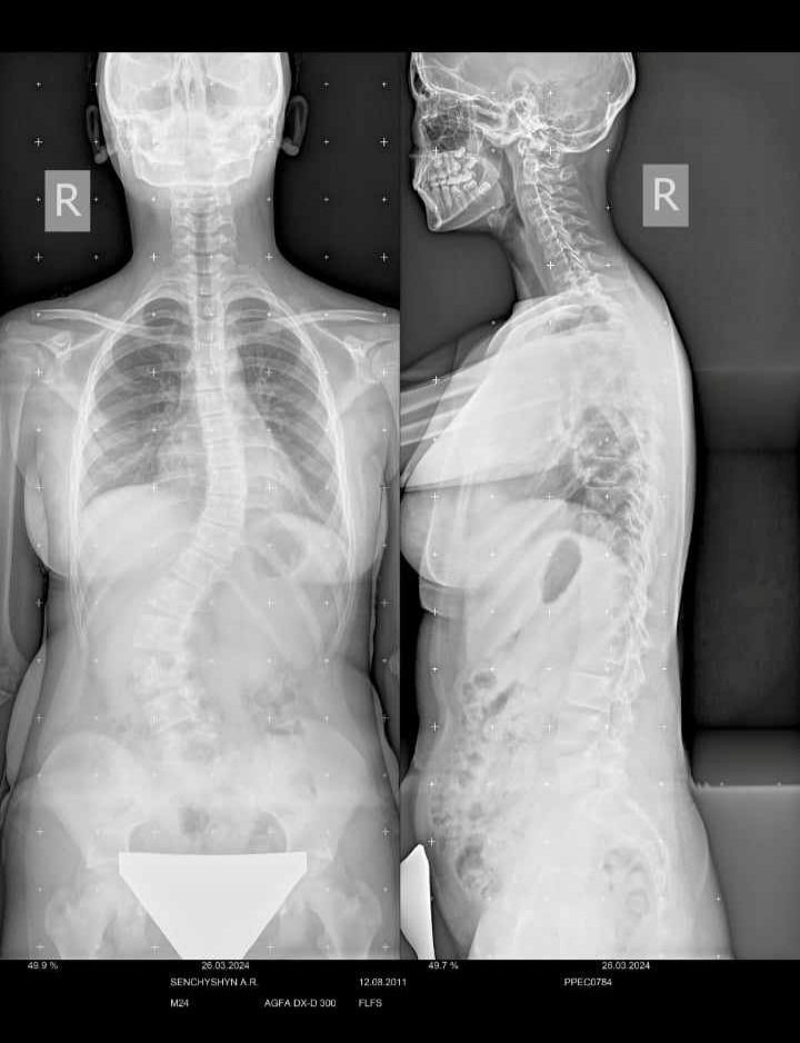 Новини Тернополя - фото з 12-річна кременчанка потребує дороговартісної операції хребта: рідні благають про допомогу
