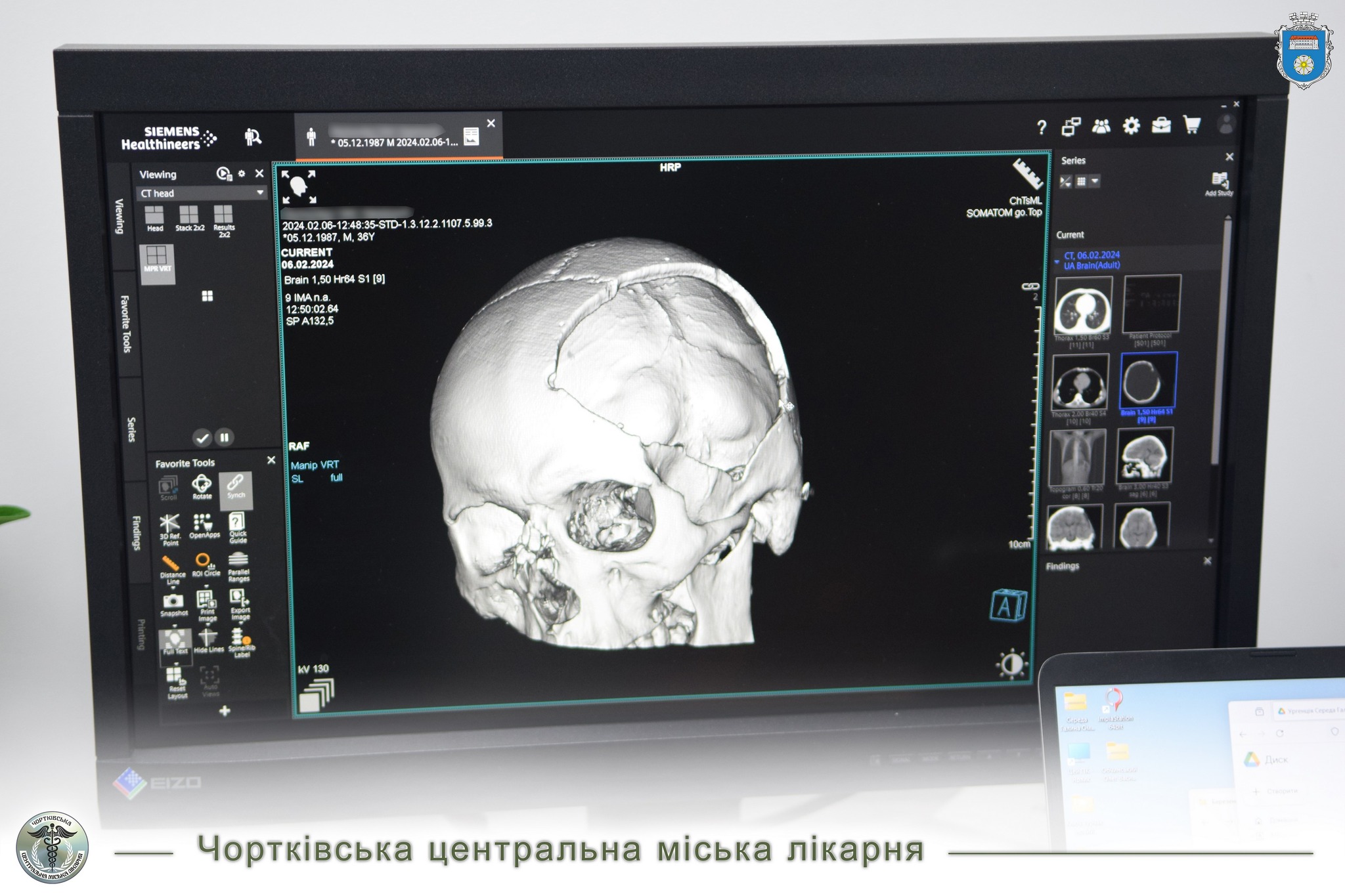 На зображенні може бути: рентген, кістка та текст