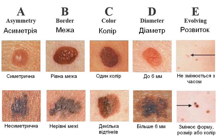 Новини Вінниці - фото з Меланома у дітей: причини, фактори ризику та профілактика захворювання