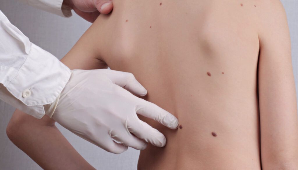 Новини Вінниці - фото з Меланома у дітей: причини, фактори ризику та профілактика захворювання