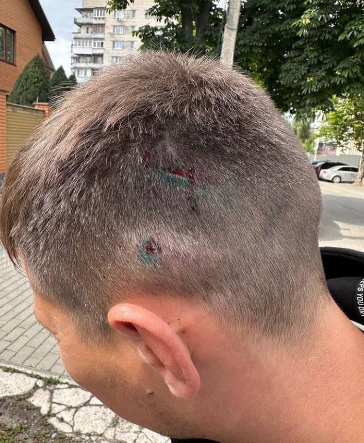 Новини Вінниці - фото з Кастетом по голові. Активіста Дорожнього контролю Вінниці побили на заправці