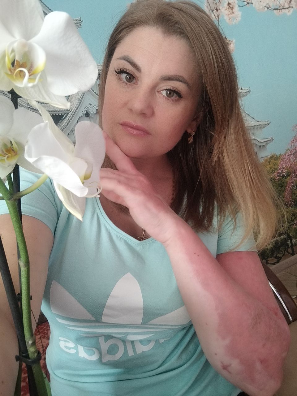 Новини Вінниці - фото з «Добре, що жива залишилась. Це були перші мої слова тоді». Про незламність постраждалої від обстрілу вінничанки