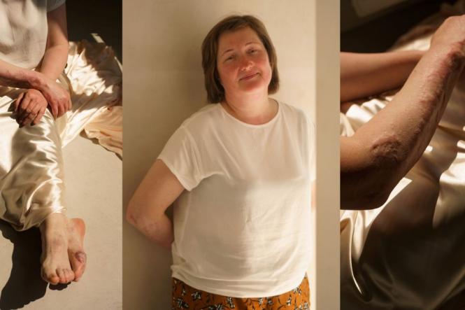 Новини Вінниці - фото з ТОП важливих новин на «20 хвилин» від 8 по 15 липня, які ви могли пропустити «Встала з того дивана і пішла. Через вогонь, через скло...» Розповідь Ірини, що дивом вижила 14 липня