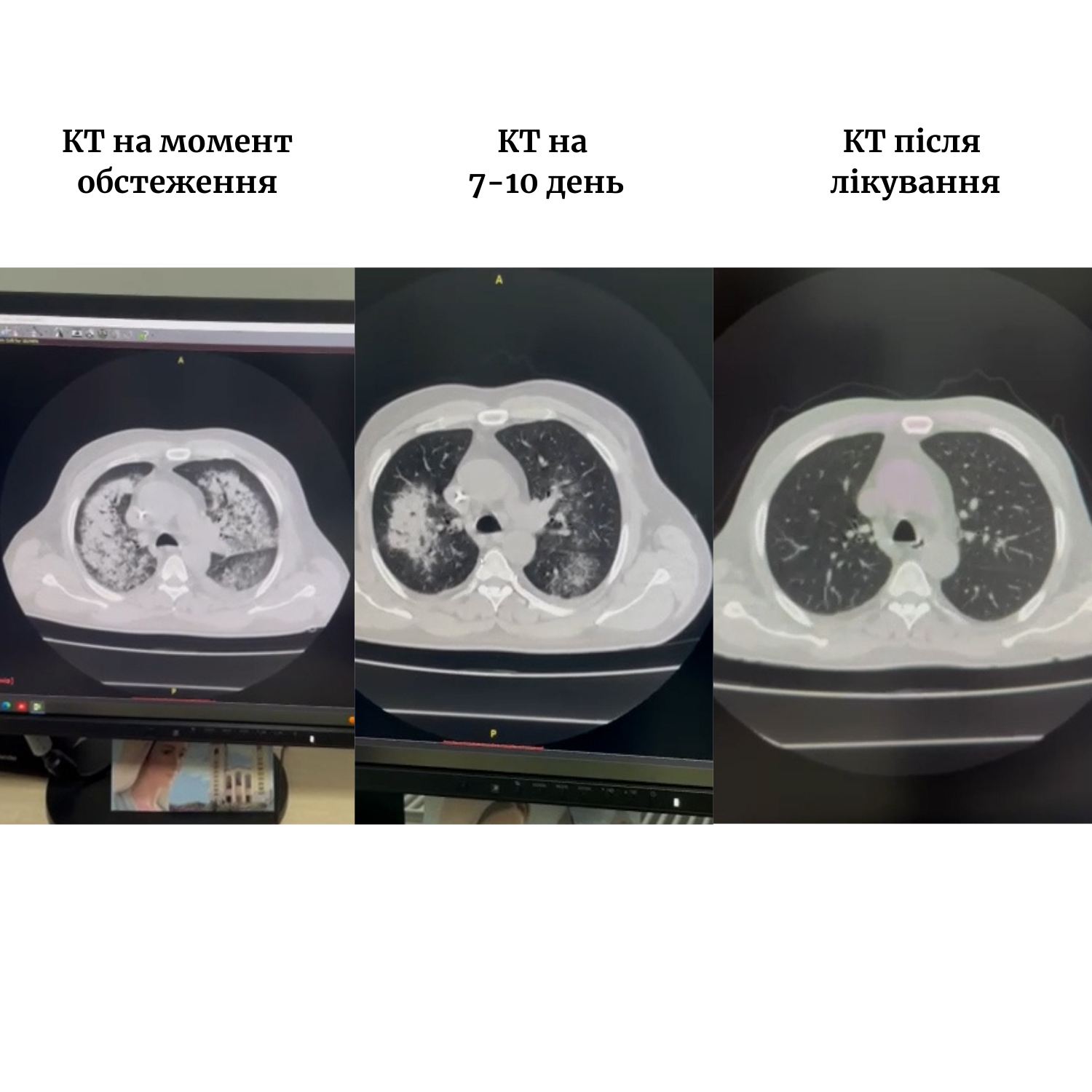 Новини Тернополя - фото з У пацієнта лікарні швидкої допомоги виявили синдром Гудпасчера: трапляється раз на 4 мільйони випадків На зображенні може бути: рентген, лікарня та текст