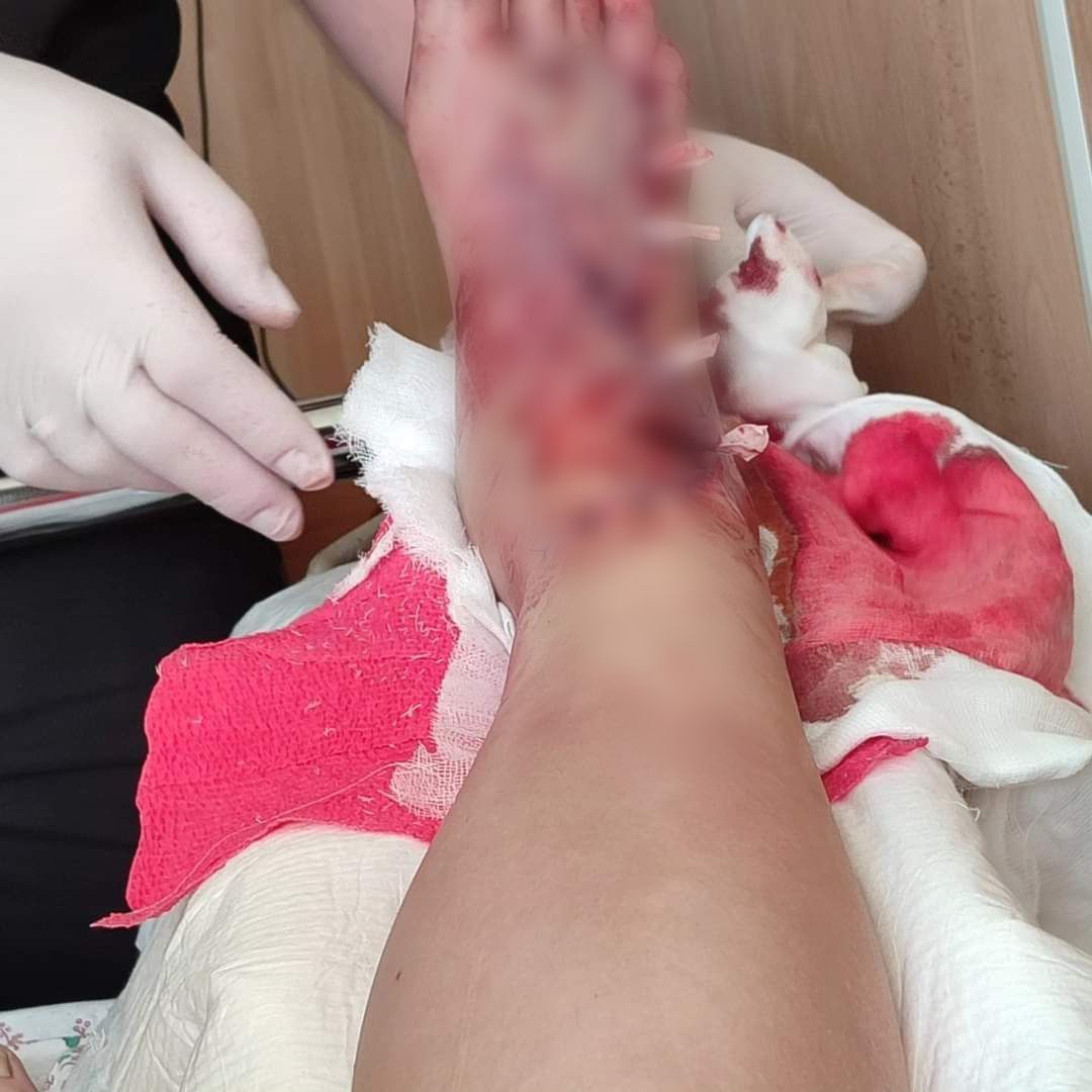 Новини Вінниці - фото з «Перша думка — мені відріжуть ногу»: у Вороновиці фура зачепила 22-річну дівчину