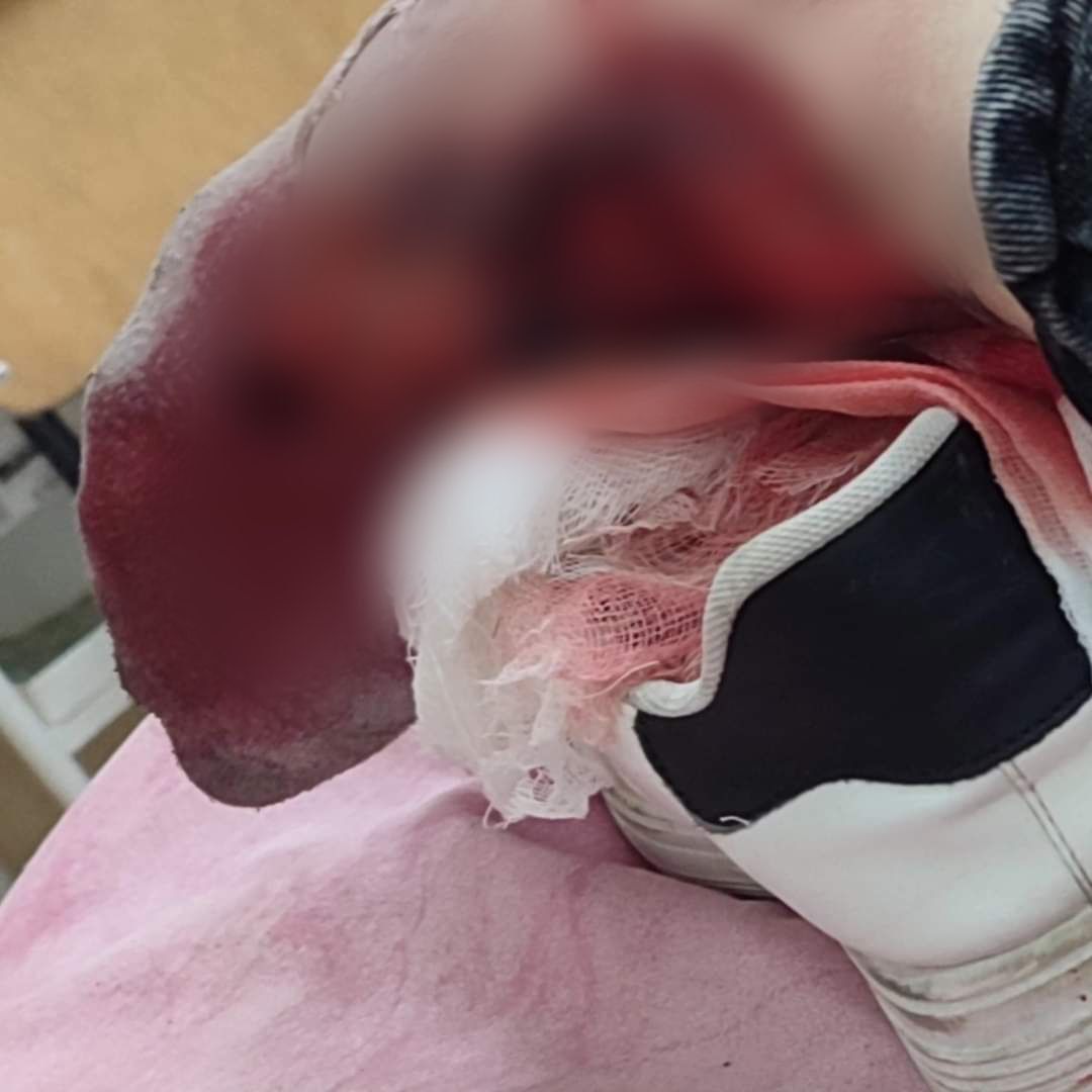 Новини Вінниці - фото з «Перша думка — мені відріжуть ногу»: у Вороновиці фура зачепила 22-річну дівчину