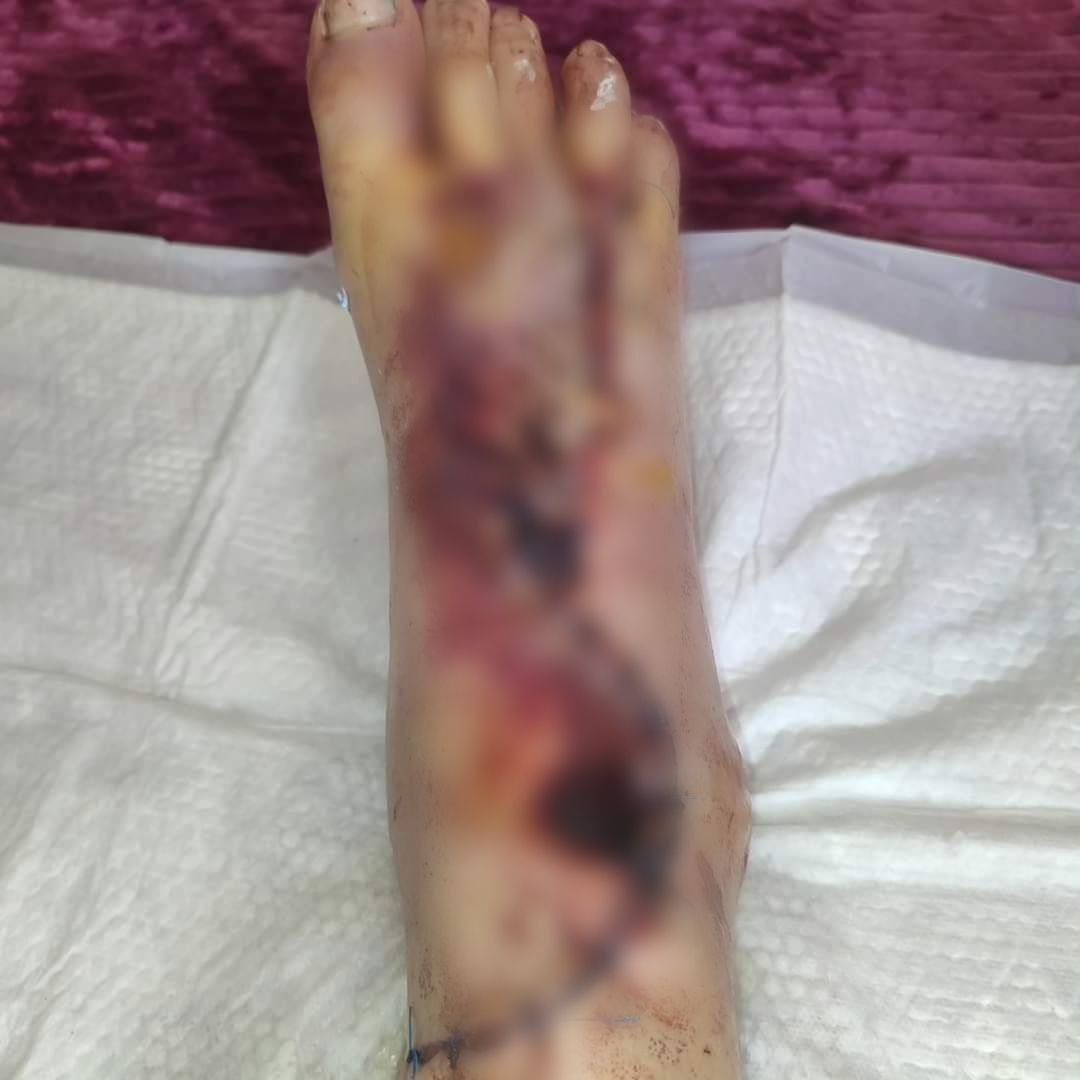 Новини Вінниці - фото з «Перша думка — мені відріжуть ногу»: у Вороновиці фура зачепила 22-річну дівчину