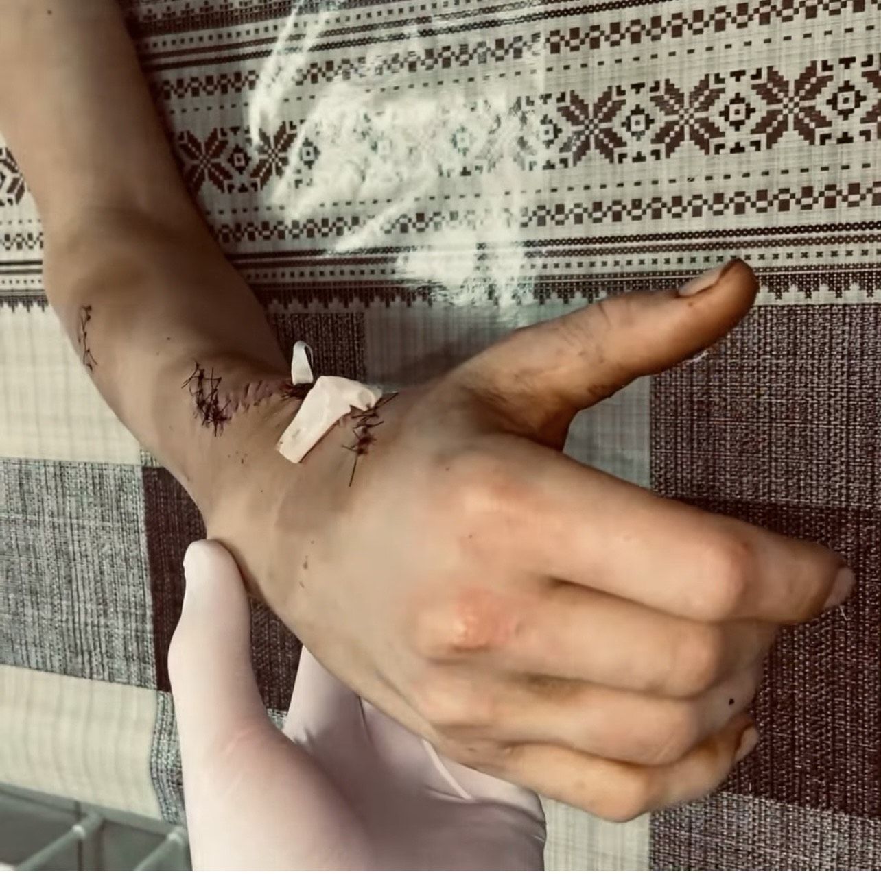 Новини Вінниці - фото з Хірурги Вінницької дитячої лікарні врятували підлітку руку після травми від бензопили