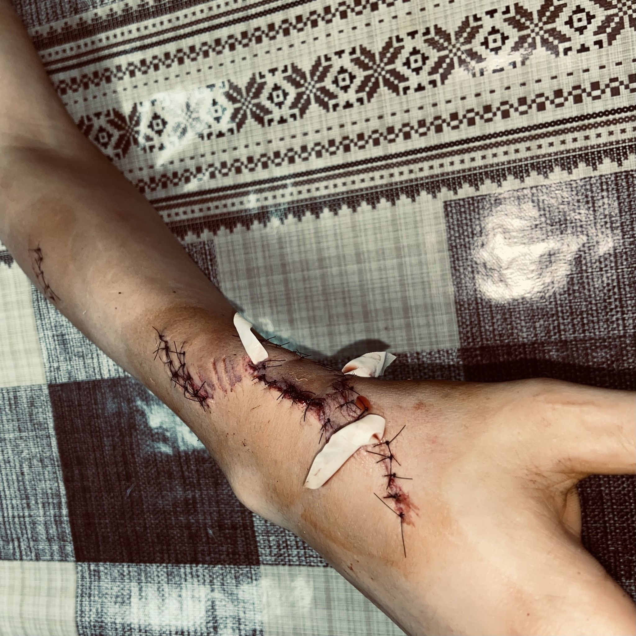 Новини Вінниці - фото з Хірурги Вінницької дитячої лікарні врятували підлітку руку після травми від бензопили