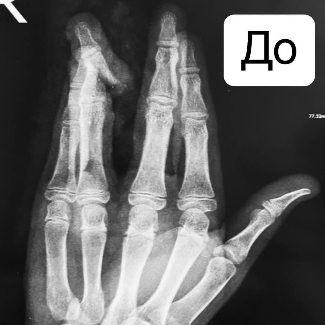 Новини Вінниці - фото з Калічать кінцівки, внутрішні органи: у Вінниці щодня на велосипедах та самокатах травмуються діти