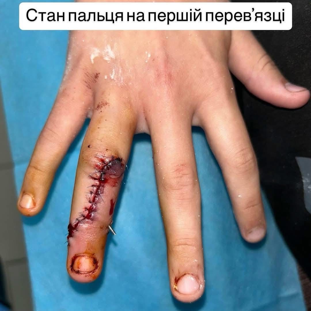 Новини Вінниці - фото з Калічать кінцівки, внутрішні органи: у Вінниці щодня на велосипедах та самокатах травмуються діти