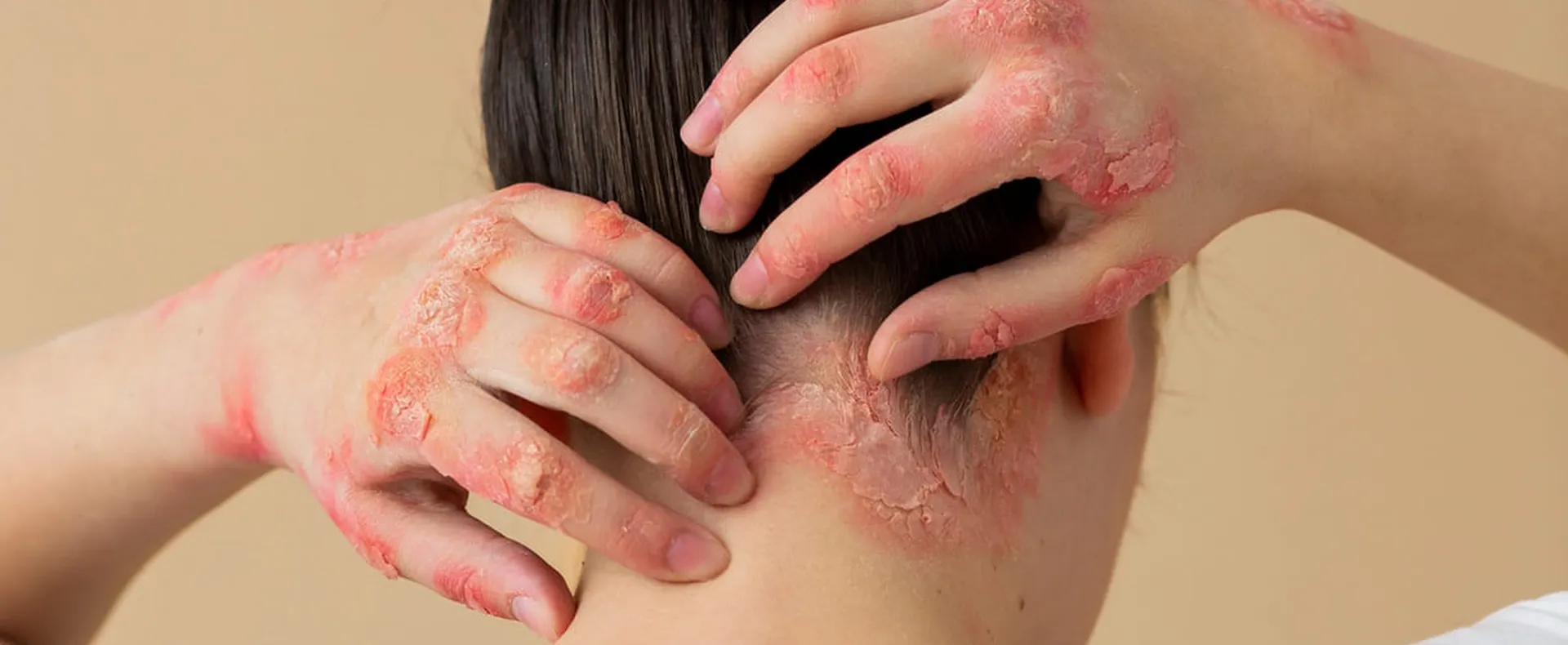 Новини Козятина - фото з Лікування псоріазу: сучасні рішення (Новини компаній)