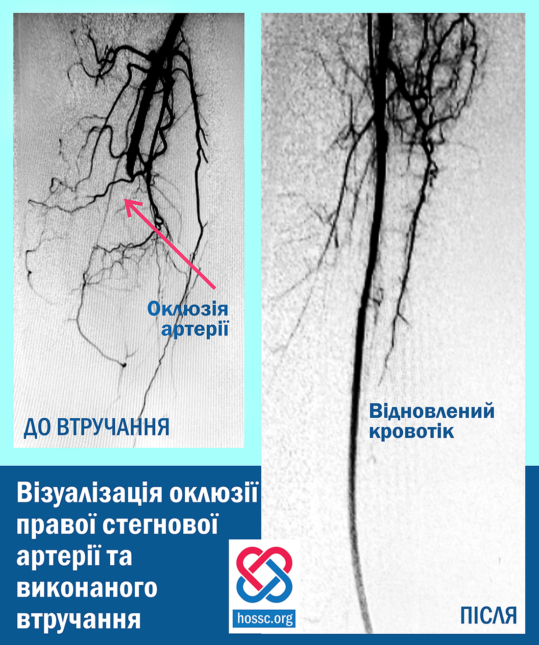 Новини Хмельницького - фото з У Кам'янці кардіохірурги врятували чоловіка від ампутації ноги