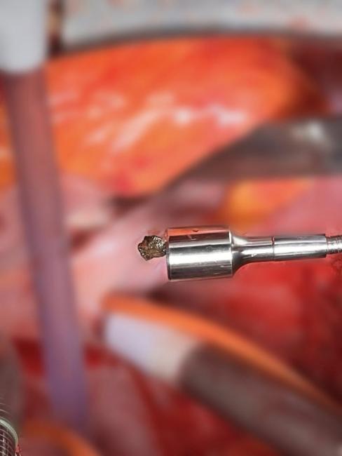 Новини Вінниці - фото з Народився вдруге – у Вінниці з серця чоловіка дістали металевий уламок