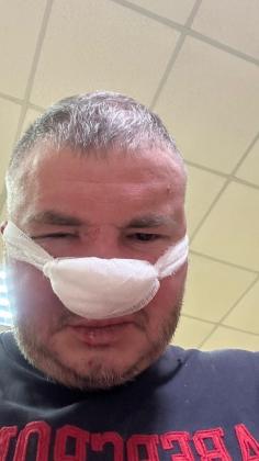 Новини Вінниці - фото з Зламаний ніс та заяви до поліції: що відомо про конфлікт директора водоканалу в Гнівані з мешканцем?