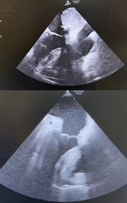 Новини Вінниці - фото з Пухлина, що «жила» в серці: у лікарні Пирогова провели складну операцію і врятували життя