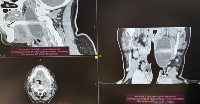 Новини Вінниці - фото з Врятували від задухи: у Вінниці провели унікальну операцію на горлі