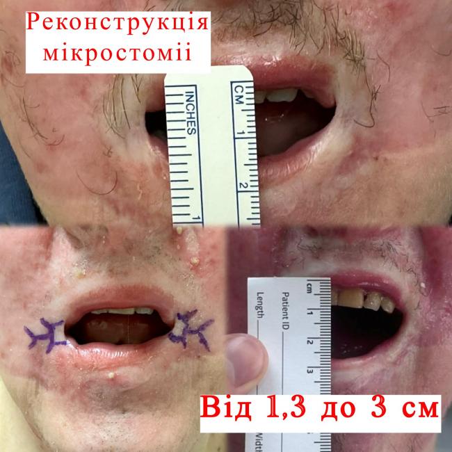 Новини Вінниці - фото з Вінницькі хірурги відновили обличчя пацієнта після опіків — фото до і після вражають