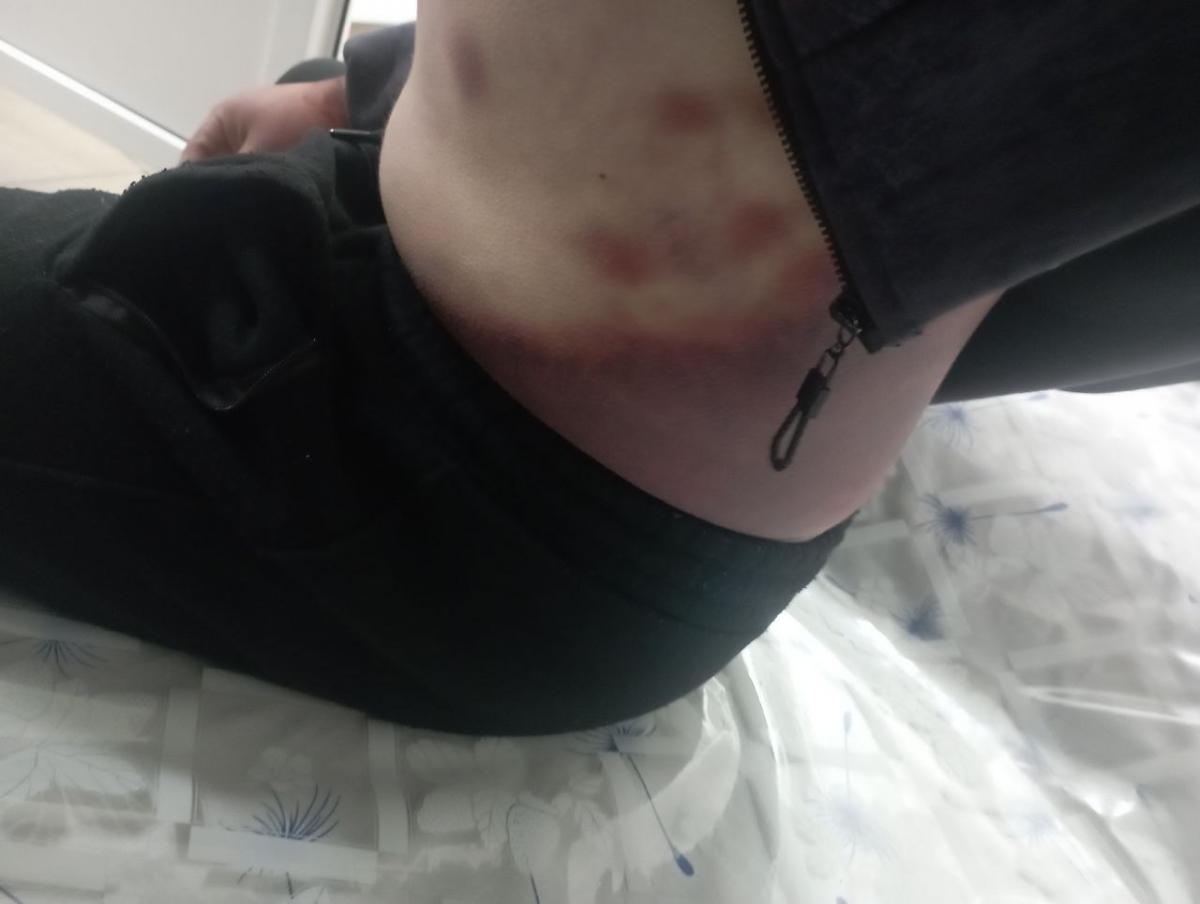 Новини Тернополя - фото з Понад місяць був у лікарні після відвідин ТЦК. Розбіжності у справі побиття мешканця Почаєва